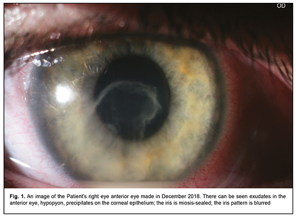 Tonometru Maklakov pentru măsurarea presiunii oculare: când și cum se utilizează - Inflamaţie 